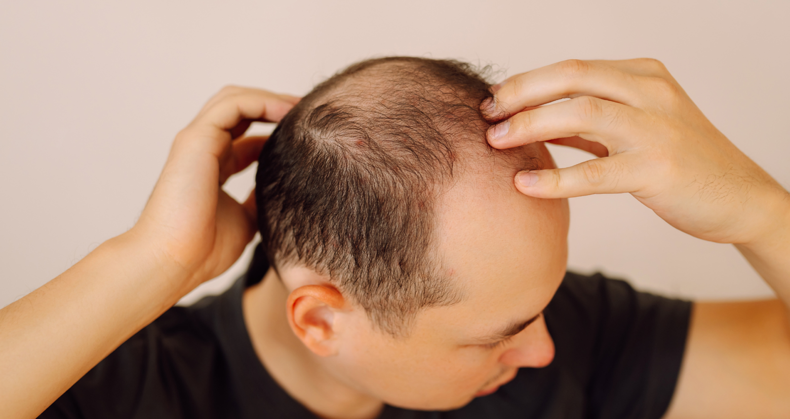 Man checking his hairline